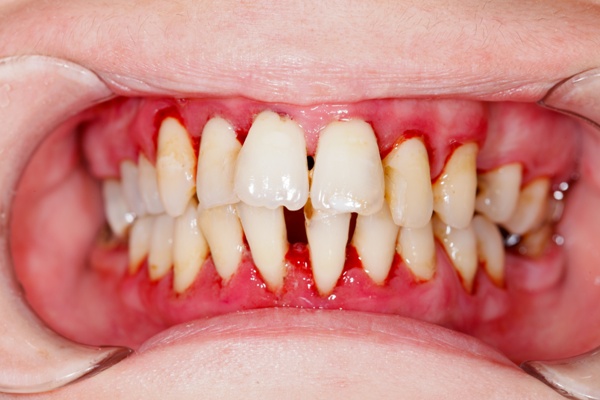 Everything You Need to Know About Periodontists post thumbnail image