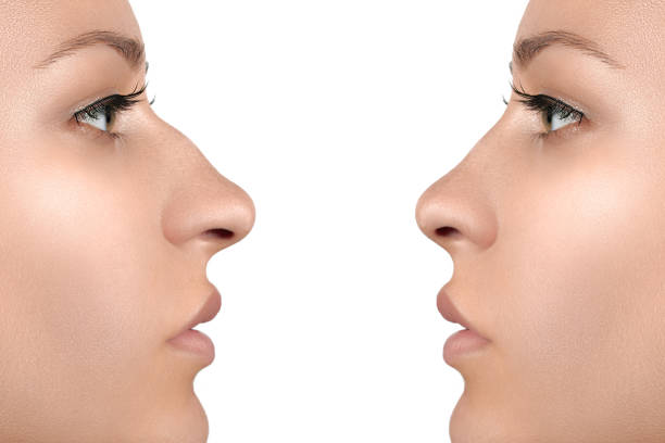 Learn how straightforward it will probably be to buy a Nose job LA at home post thumbnail image
